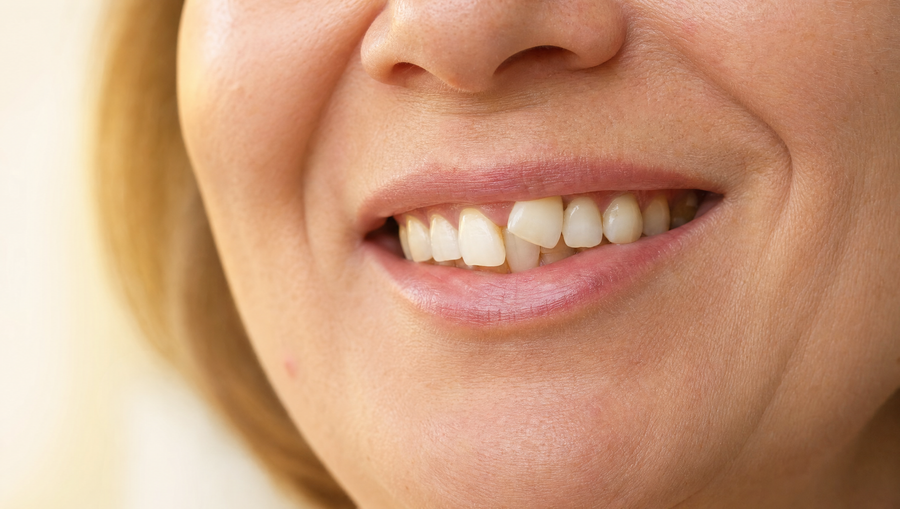Smile with crooked front teeth