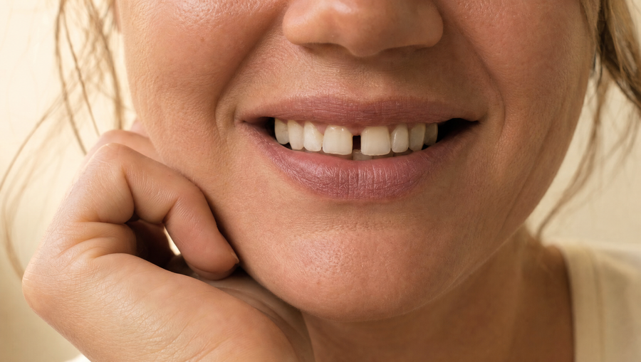 Smile with a gap between the front teeth